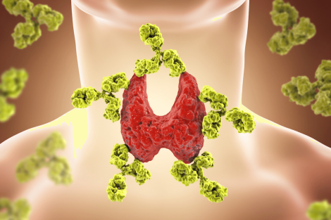 imagen-carrusel-tiroidesAcerca de la tiroiditis de Hashimoto